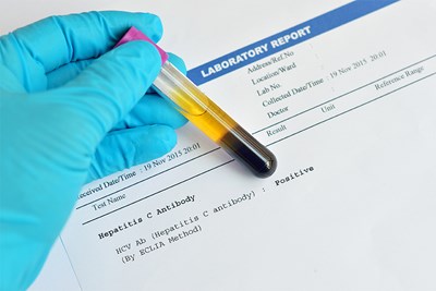 Recent Advancements in Hepatitis C Treatment