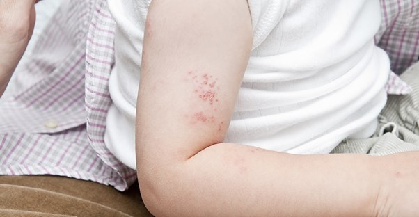 A child with chickenpox