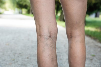 Symptoms of Deep Vein Thrombosis