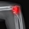 Tennis Elbow: 9 Terms to Know