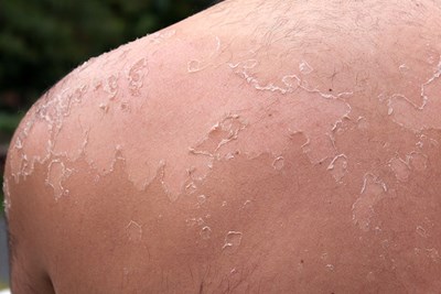 What's the Chance of Getting Skin Cancer from a Sunburn? 