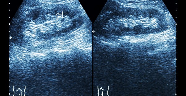 A kidney stone ultrasound