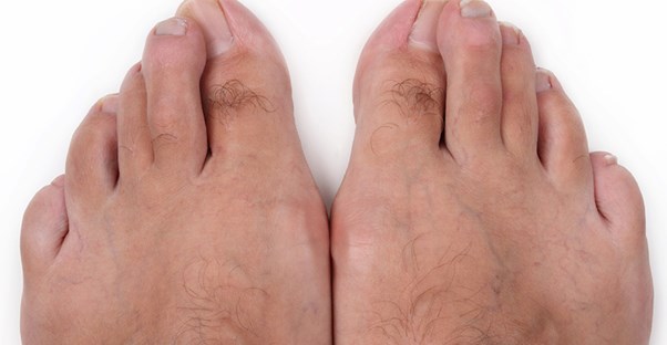 Some toes with bunions