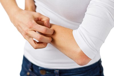 What is Hand Dermatitis?