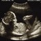 Spina Bifida Causes