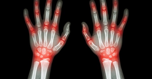 arthritis symptoms highlighted on an x-ray of hands