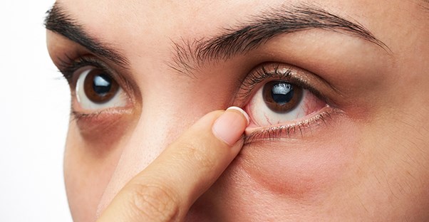 woman with dry eye symptoms
