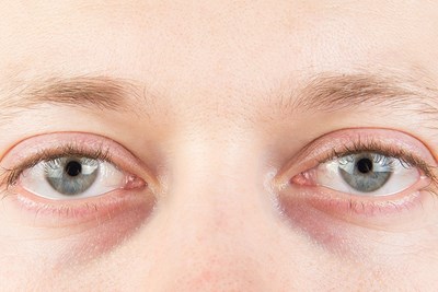 Dry Eye Home Remedies