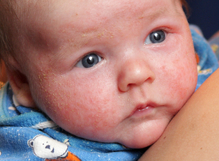 Eczema in Babies