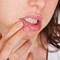 Chapped Lips Symptoms