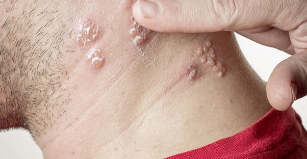 a man shows signs of shingles on his neck
