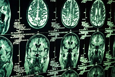 What Complications Can Arise From Traumatic Brain Injuries