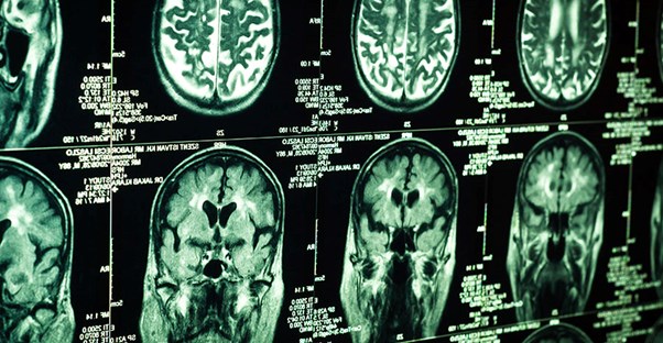 Brain scan. Causes of traumatic brain injury.