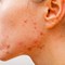 What Causes Acne?