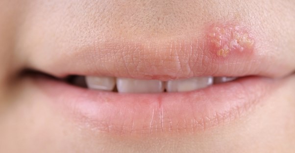 a close up of a cold sore on an upper lip