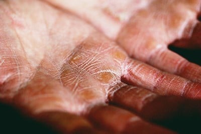 Severe Atopic Dermatitis: Symptoms and Treatment
