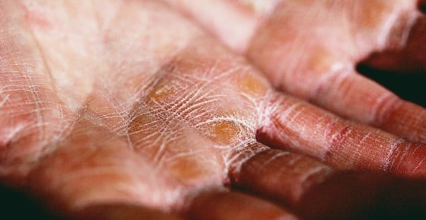 Severe Atopic Dermatitis: Symptoms and Treatment