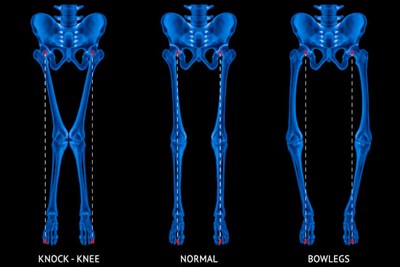 A Parent's Guide Rickets Disease