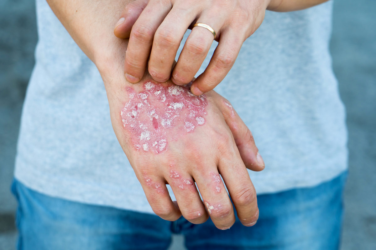 Colorado – Syphilis