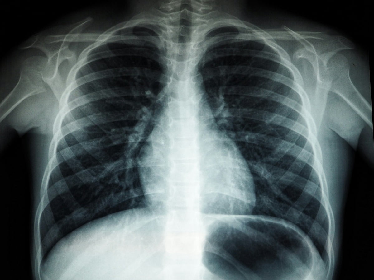 Symptoms of a Clot in the Lung