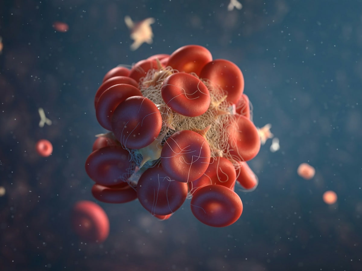 What Is a Blood Clot in the Leg?