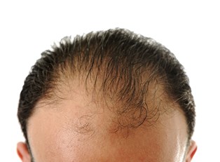 What Causes Baldness?