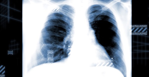 an X-ray used to diagnose emphysema