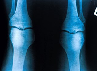 What is an ACL?