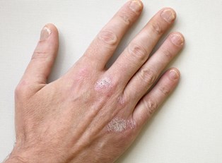 What is Psoriasis?