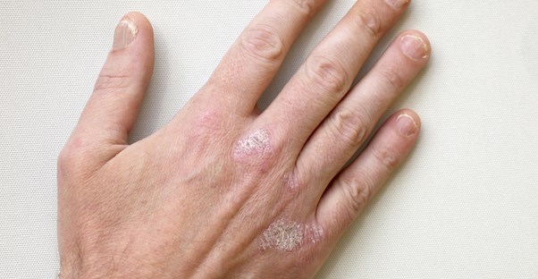 a hand shows signs of psoriasis