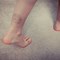 Hemophilia Symptoms