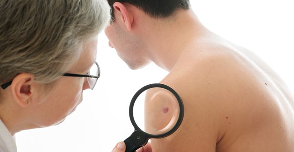 a doctor inspecting a patient for melanoma signs and symptoms