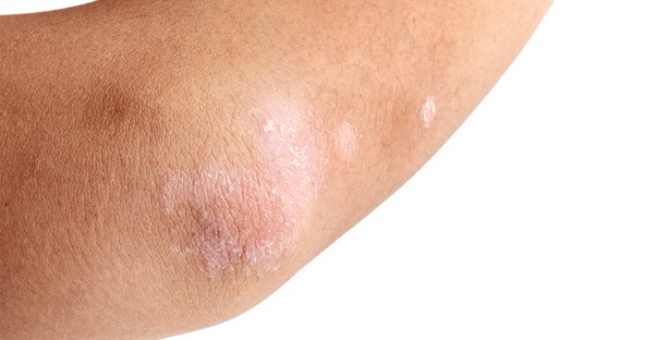 a person with seborrheic dermatitis