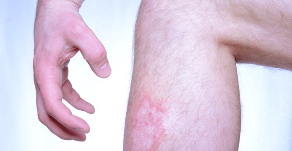 a person hoping for an atopic dermatitis treatment