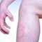 Atopic Dermatitis Treatments