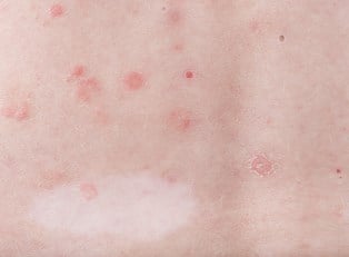 What is Guttate Psoriasis?