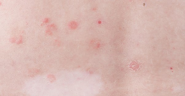 skin with guttate psoriasis