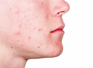What is Cystic Acne?