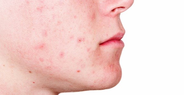 a man suffering from cystic acne