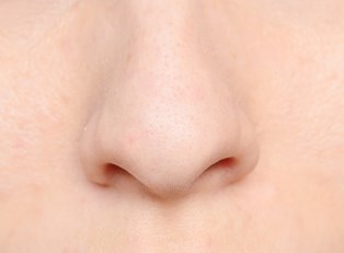 What Causes Blackheads?
