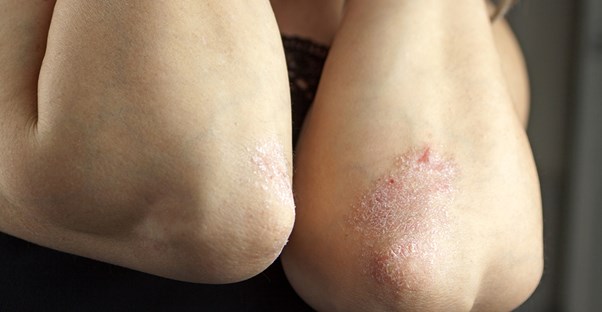 a woman suffering from plaque psoriasis