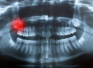 What are Impacted Wisdom Teeth?
