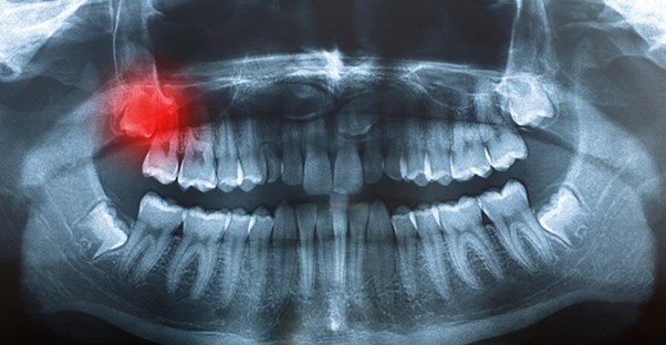 an image of an impacted wisdom tooth