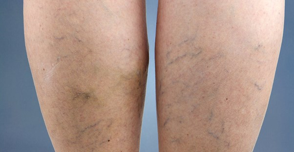 a woman with spider veins
