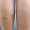 What Are Spider Veins?