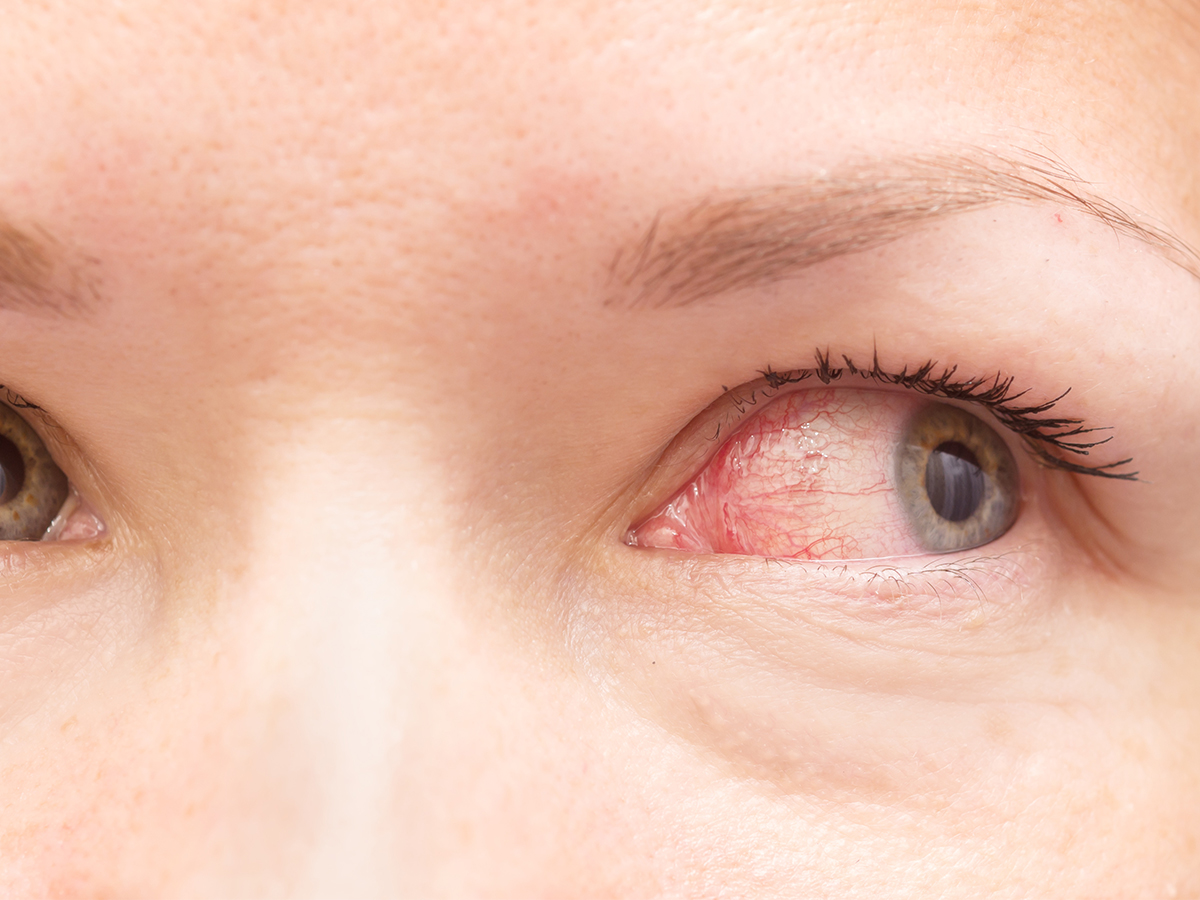 What Are the Symptoms of Pink Eye?