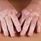 What is Vitiligo?