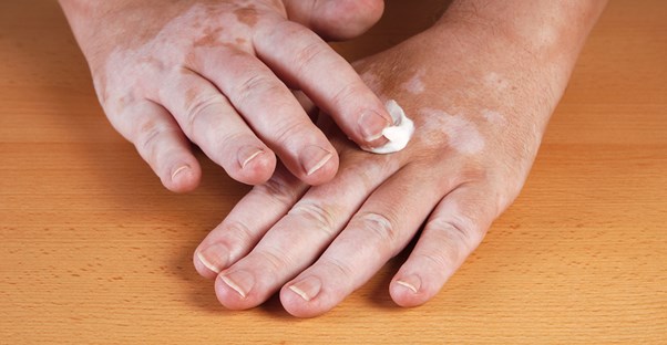 a man applying vitilago treatments