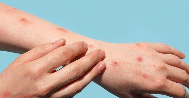 Chickenpox and Shingles: All You Need to Know in 10 Photos main image