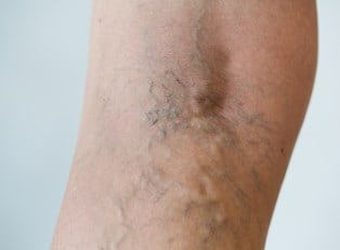 Spider Veins: 10 Terms to Know